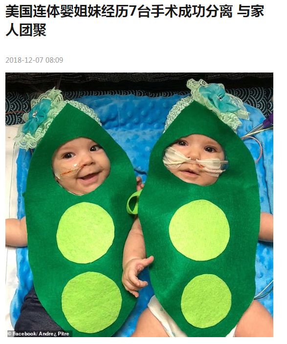 这对要上牛津剑桥的姐妹花,16年前是连体婴!存活率仅百万分之一