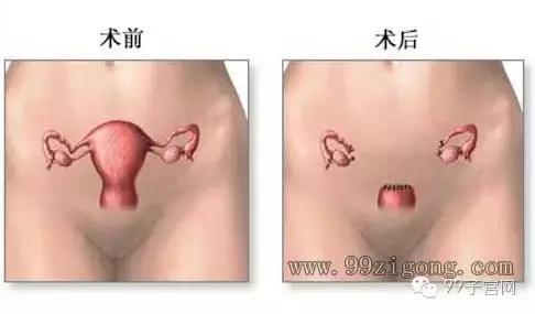 女人可以没有子宫么,如果女人没了子宫会怎么样