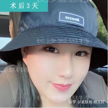 哪些人群不适合做热玛吉?