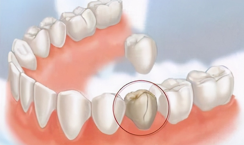 蛀牙的克星有哪些,蛀牙根管治疗还是补牙