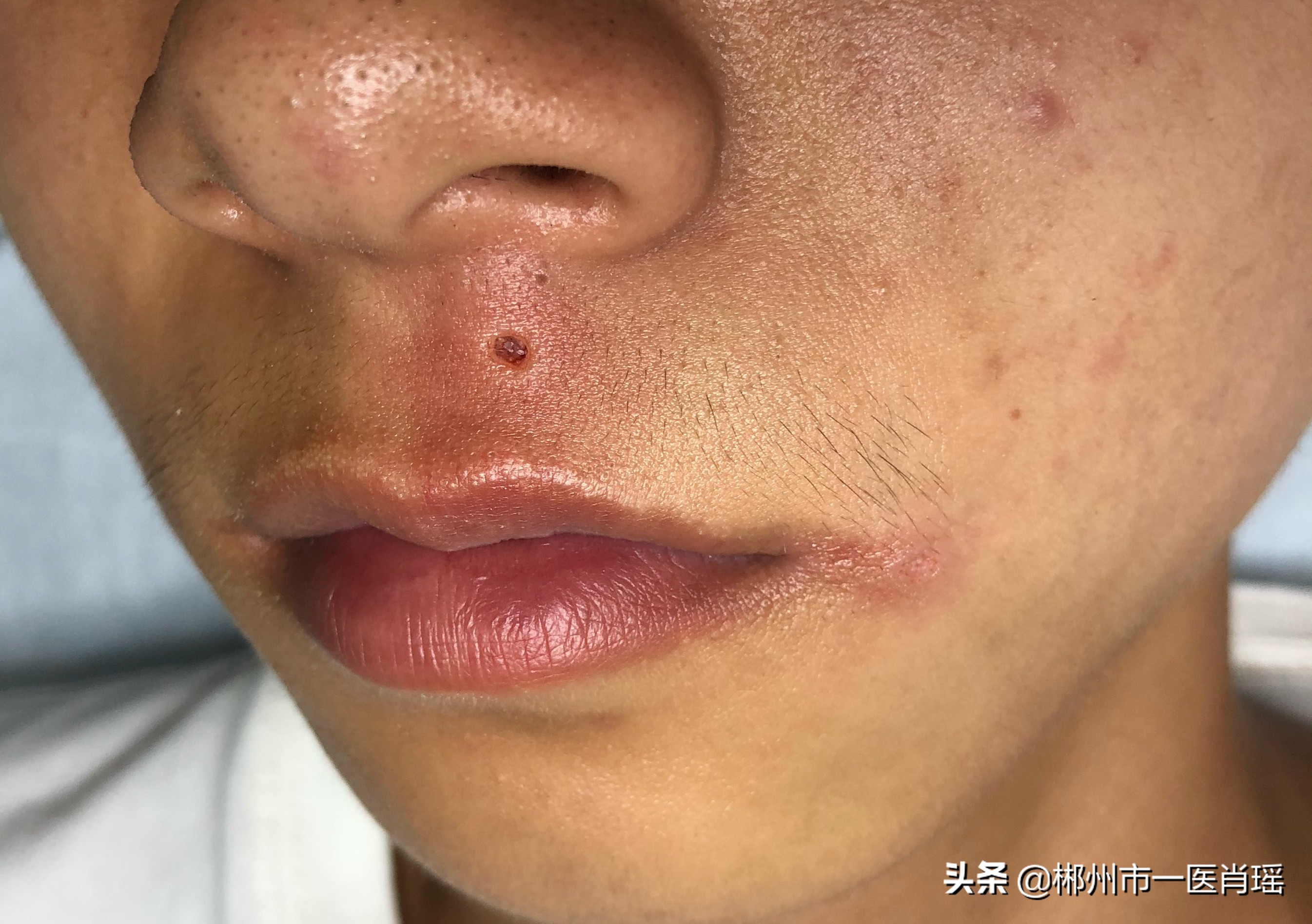 点痣留下的凹坑用点阵激光,为什么激光点痣会留疤