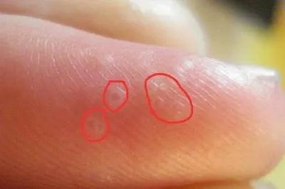 为什么一到夏天手上就长水泡很痒,一到夏天就痒长水泡