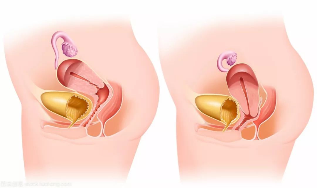 女子子宫脱垂如何保健恢复,省人民医院妇科治疗子宫脱垂
