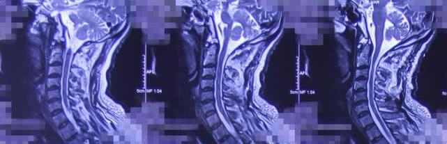 椎管内肿瘤跟椎管肿瘤一样吗,椎管内肿瘤是癌吗