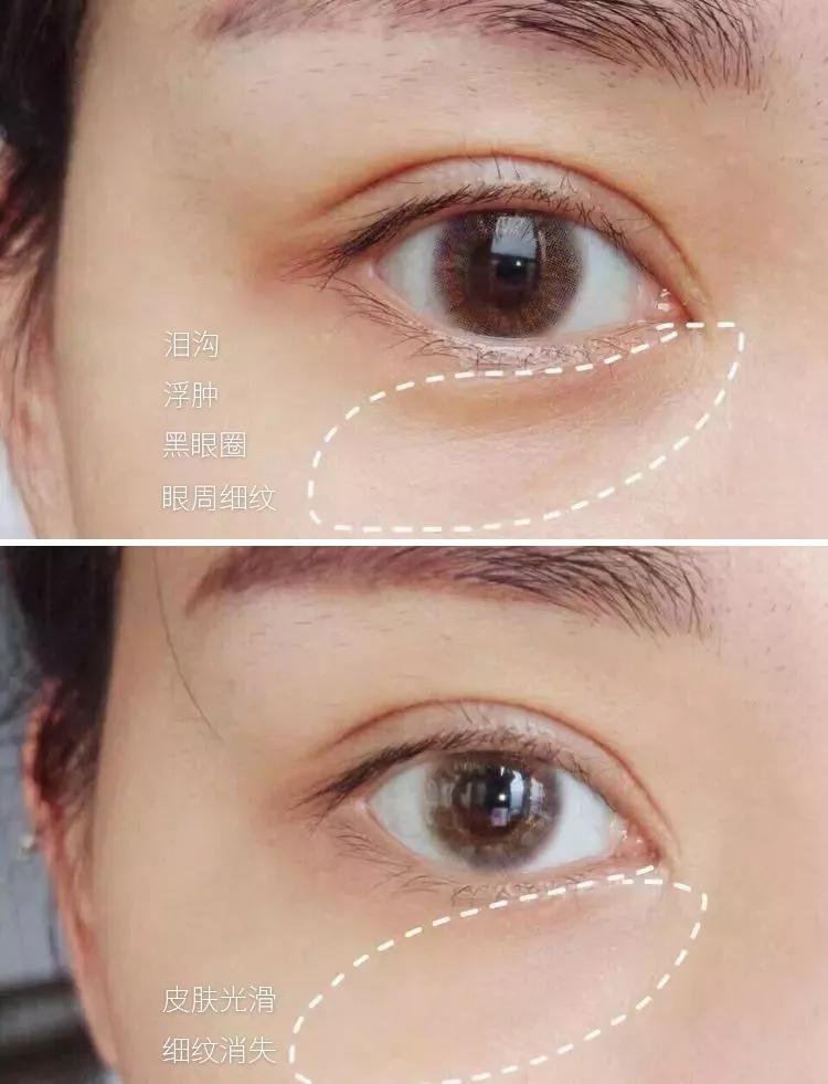 脂肪粒怎么用针挑出的,脂肪粒多久可以用针挑出来