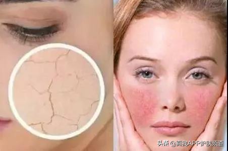 脸上长痘痘反反复复该怎么办,脸上一个部位反反复复长痘痘