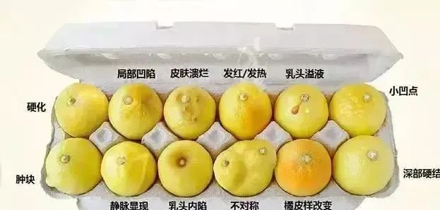 23岁年轻女孩查出乳腺癌,23岁姑娘得了乳腺癌