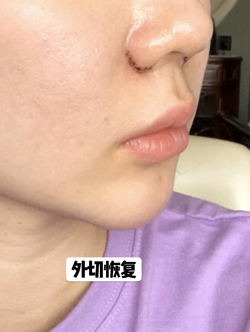 鼻翼缩小可以单独做吗,鼻翼缩小可以内切吗