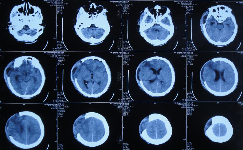 开颅手术后颅内细菌感染图片,外伤开颅手术后脑积液能恢复吗