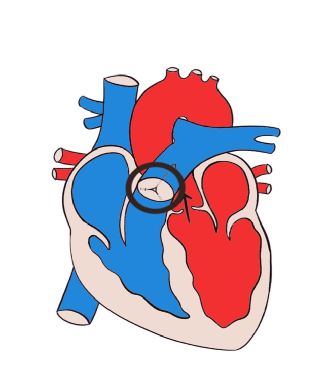 肺动脉瓣狭窄是先天性还是后天,先天性肺动脉瓣狭窄能上保险吗