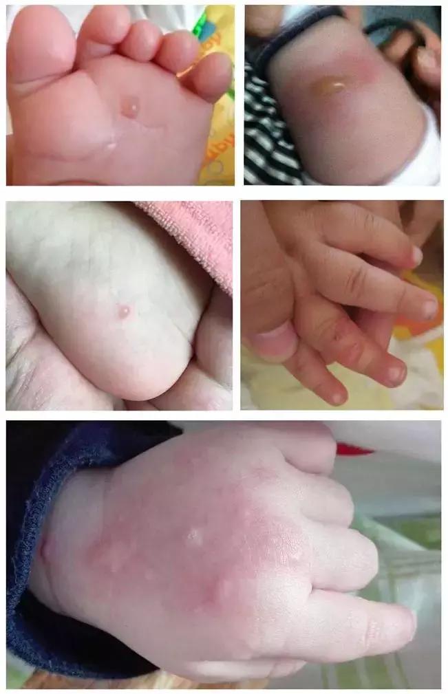 宝宝被蚊子咬了出现透明水泡,宝宝被小黑蚊咬过后留了印子