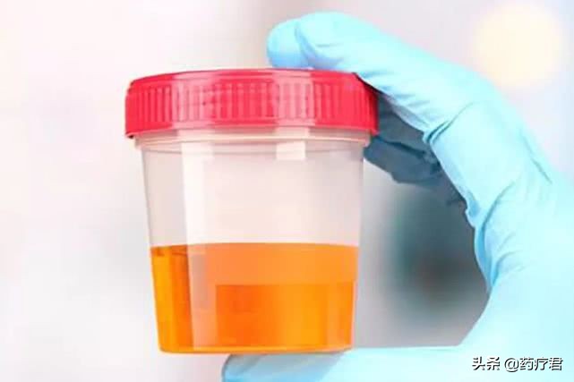 尿特别臭是肾出问题了吗,尿很臭是肝有问题吗