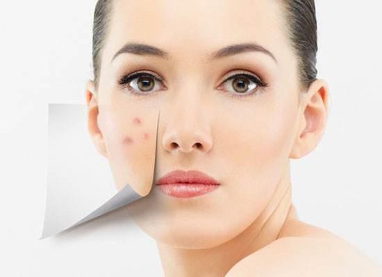 祛痘好方法更快更有效,祛痘最真实的方法