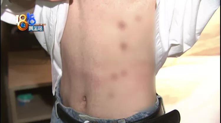 化学药物点痣留下疤,皮肤抑菌膏祛痣