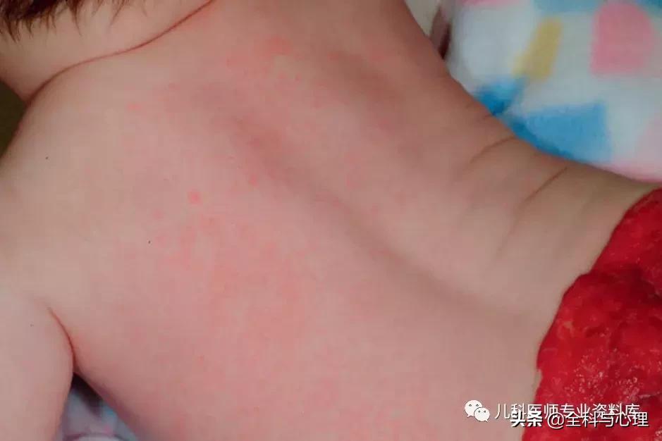 儿童痱子和湿疹，千万要分清楚了
