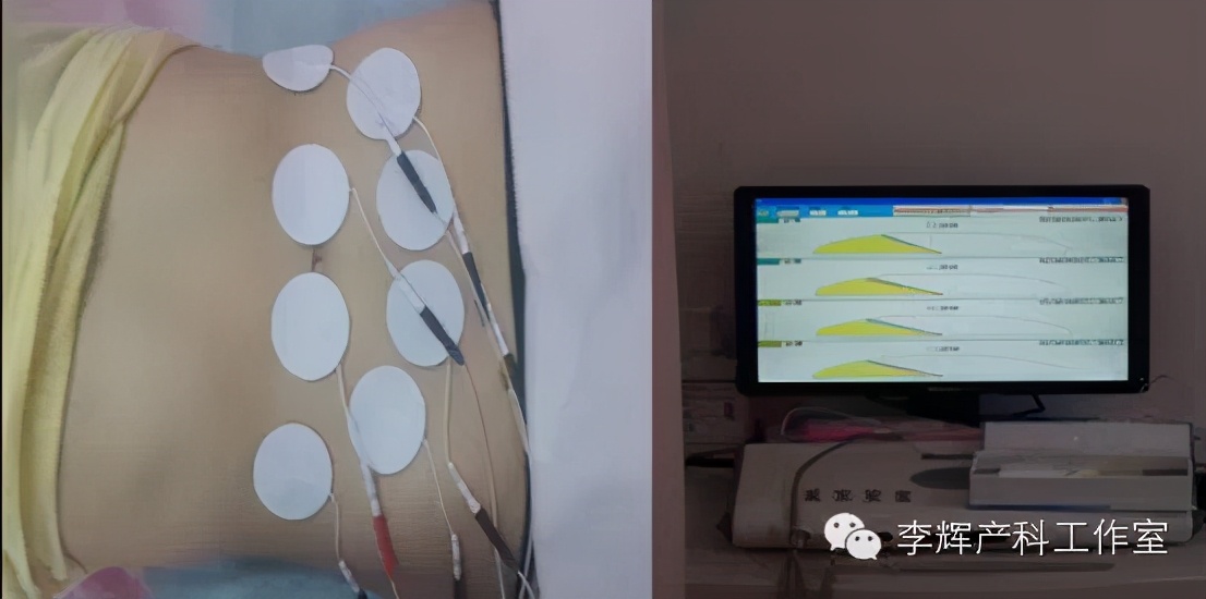 顺产后42天复查建议盆底康复治疗,产后42天复查医生要求做盆底康复