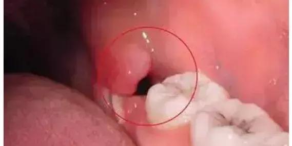 拔完牙吐口水有血,拔完牙为什么不能吐口水