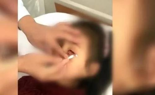眼内异物巧取办法,眼内异物取出术操作步骤