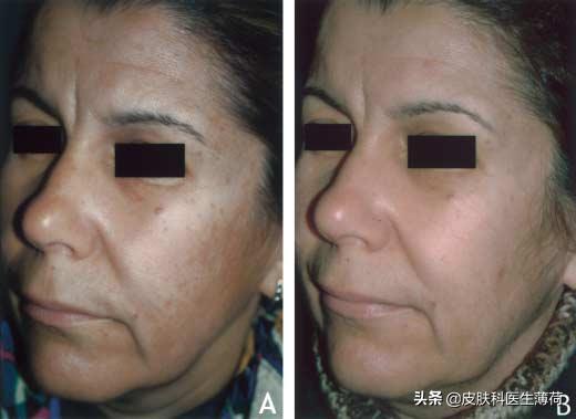 刷酸用果酸还是水杨酸,医生不会告诉你祛脚气的秘密