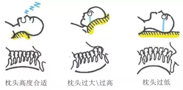 落枕了上下动不了30秒自愈方法,落枕了疼脖子动不了教你快速缓解