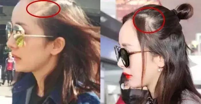 如何解决秃头和发际线高,脂溢性脱发头顶秃怎么办