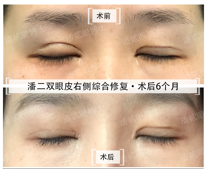 双眼皮修复具体要问什么,双眼皮修复过程中注意事项