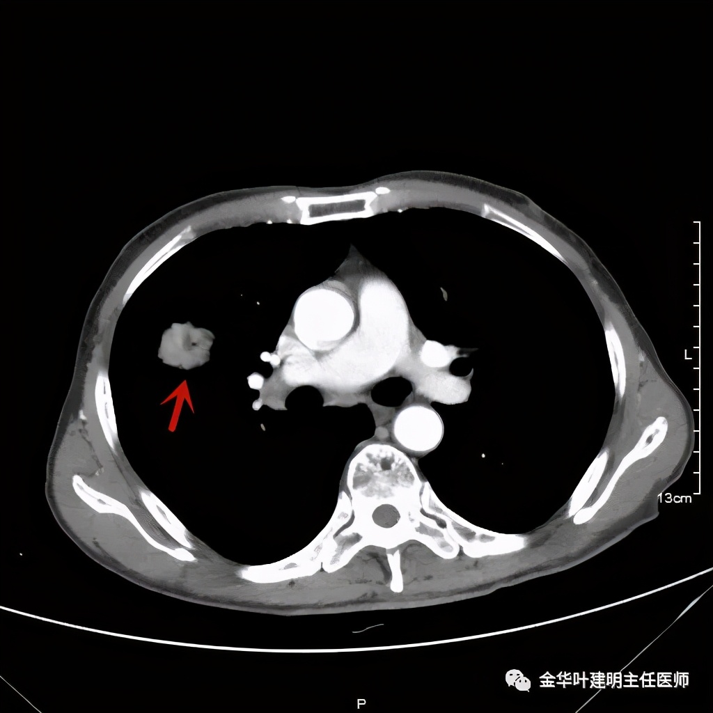 得了肺癌做肺部穿刺有影响吗,肺部穿刺可以确诊肺癌吗