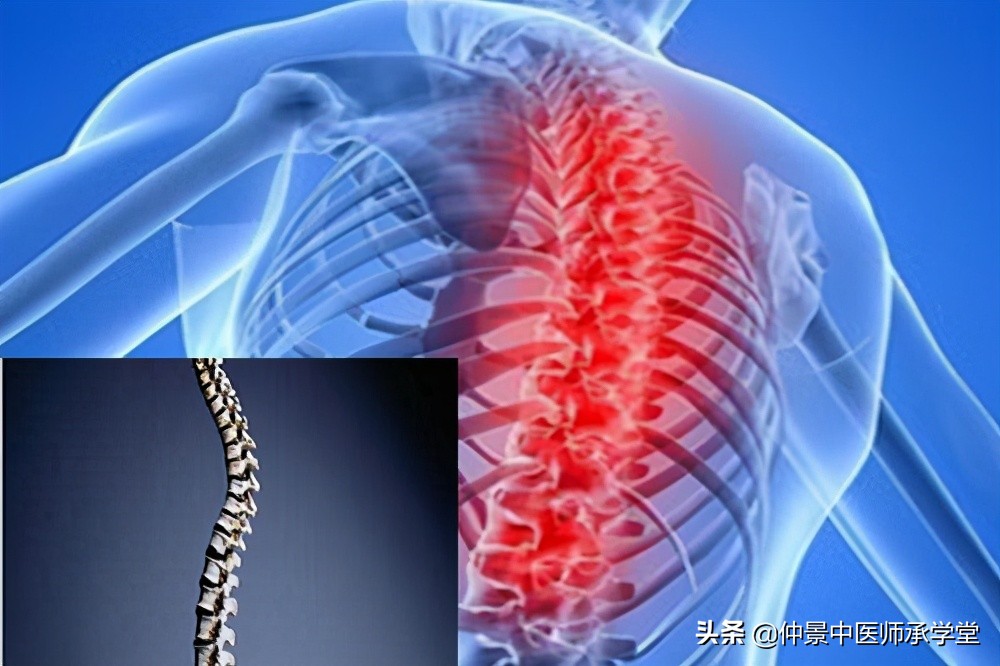 中药治疗强直性脊柱炎最佳方法,中草药偏方可治愈强直性脊柱炎吗