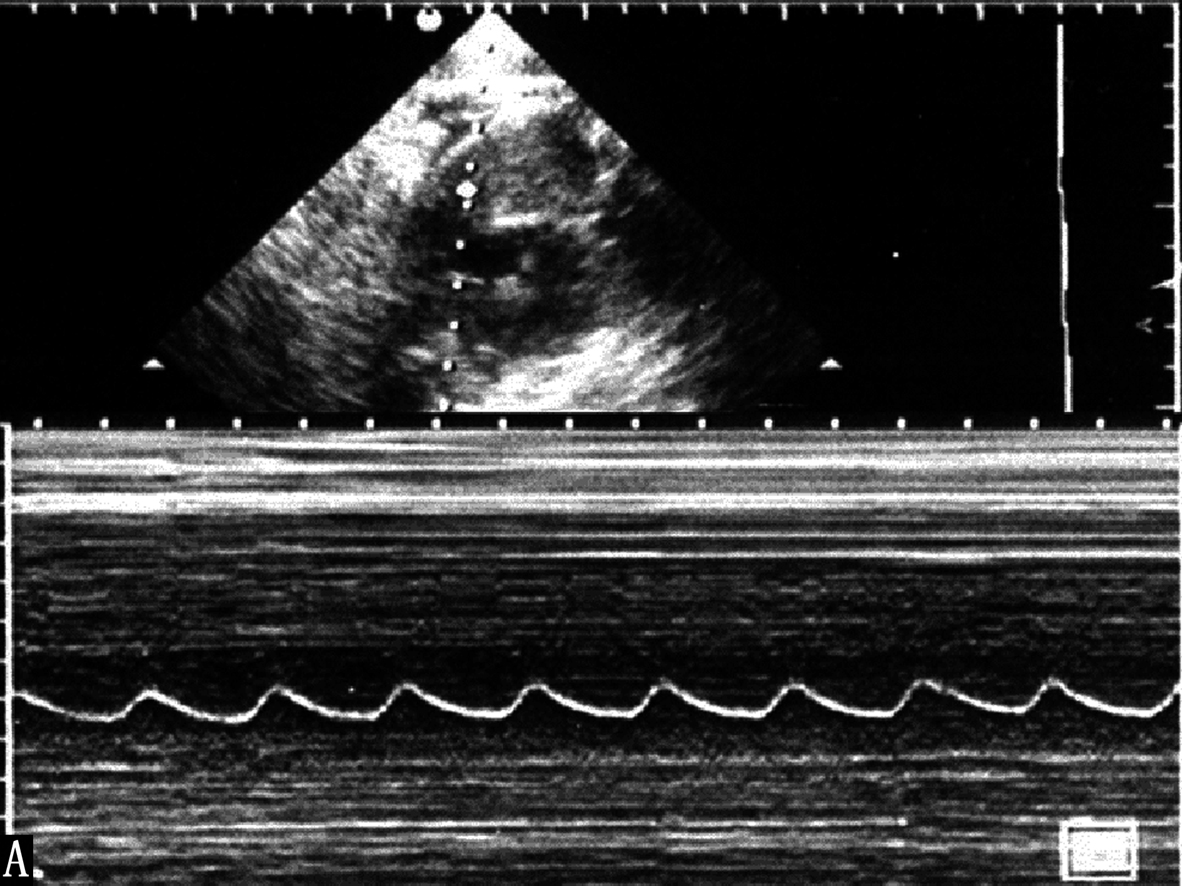 做胎儿心动图胎心165次每分,做彩超胎儿动来动去