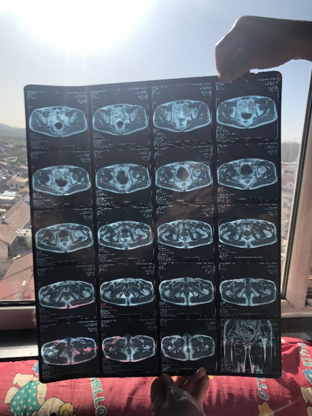 股骨头坏死医院怎么样治疗,股骨头无菌性坏死病因是多少种