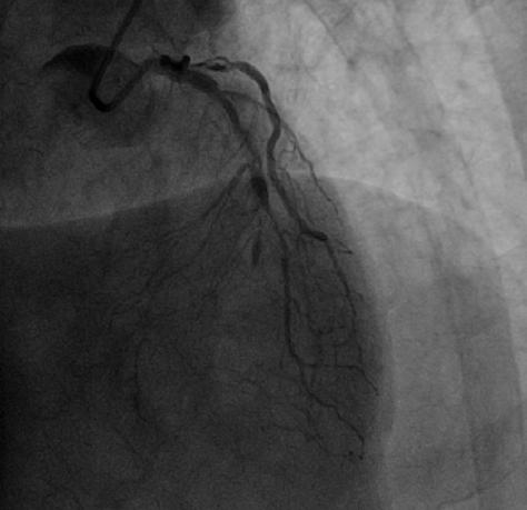 北京积水潭医院心内科成功开展医疗新技术！准分子激光冠脉消蚀术与冠脉旋磨术治疗冠脉钙化病变