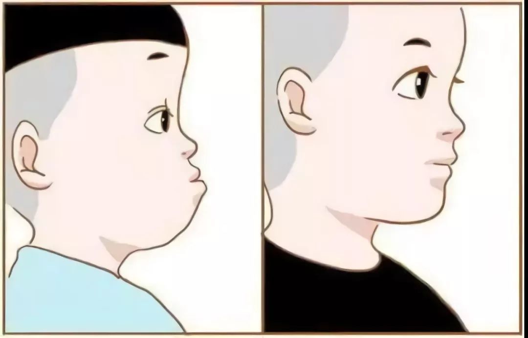 地包天科普主题,孩子地包天的治疗方法