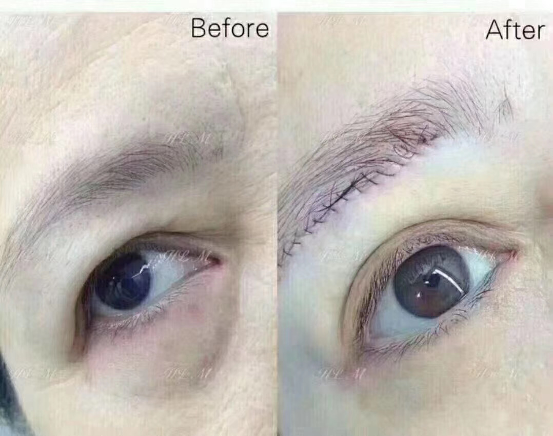 一举三得的起针方法,一举三得