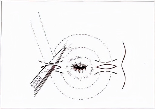 火爆全网的提肛运动，真的有那么神奇吗？|健康解密