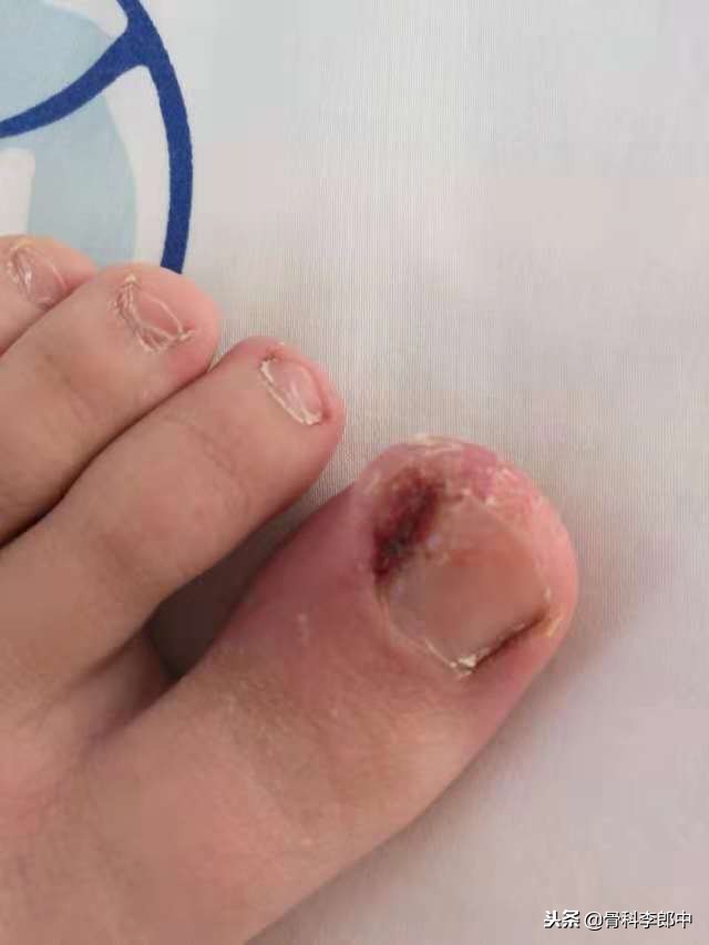 治疗甲沟炎偏方,嵌甲甲沟炎怎么自己剪指甲