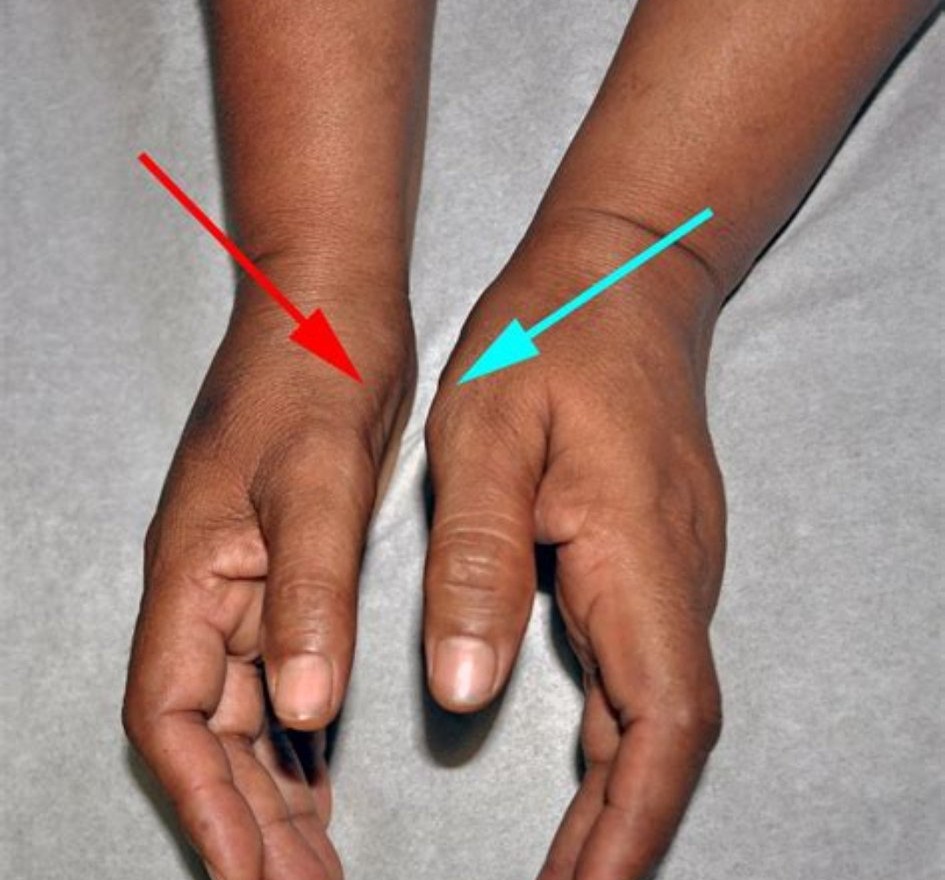 手麻木病症,手部麻木症