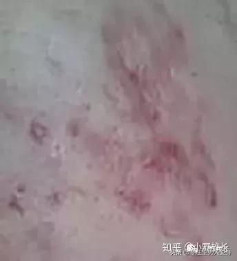 祛痘印有效的精华,祛痘印最有效的方法有4招