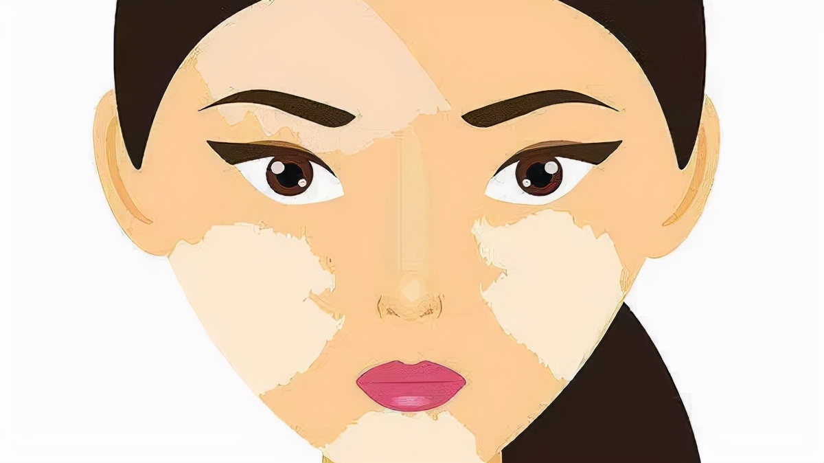 白癜风是怎么引起的怎么去除,白癜风白斑是什么引起的