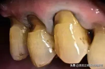 正确的刷牙方法是横刷法对不对,刷牙方法是横刷法还是竖刷牙法