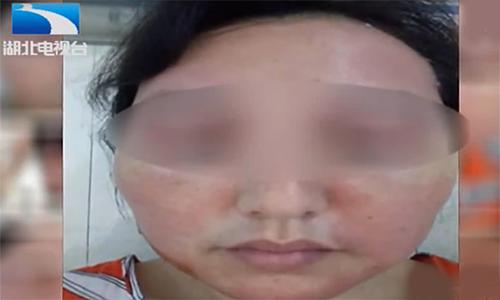 女子贴面膜毁容,女子敷面膜脸部红肿