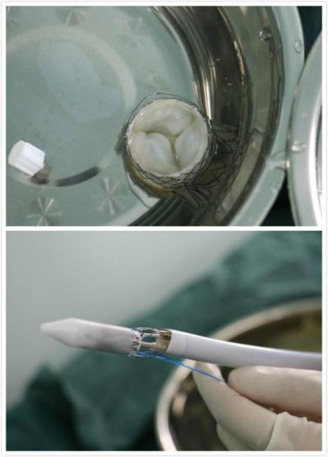 心血管病患者新希望——沈医二院成功完成一例TAVI手术