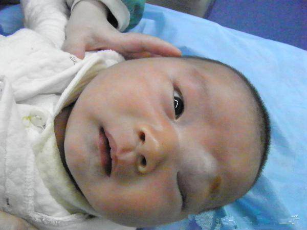 宝宝出生时头上挤了个包,宝宝出生时头上的包变硬咋回事