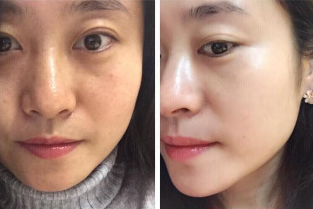 美白针是违法的吗,美白针出事的几率