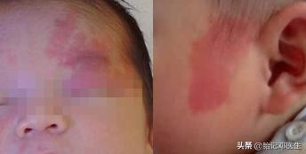 听说红胎记是福气的象征？你信不信