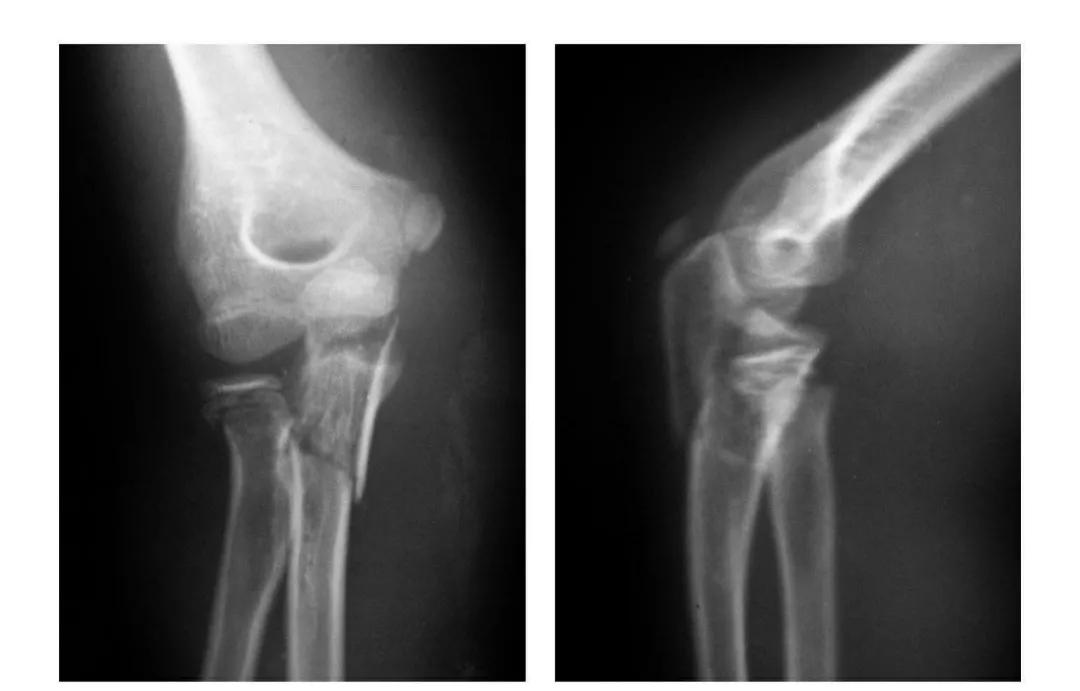 青少年肘部损伤最常见的是,肘部桡神经损伤的临床表现