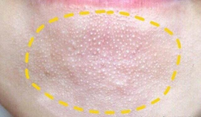 小孩下巴长白色颗粒小凸起,下巴小颗粒和粉刺怎么去除