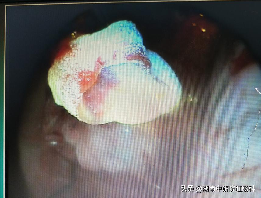 低位直肠癌早期能保肛吗,低位直肠癌晚期治愈吗