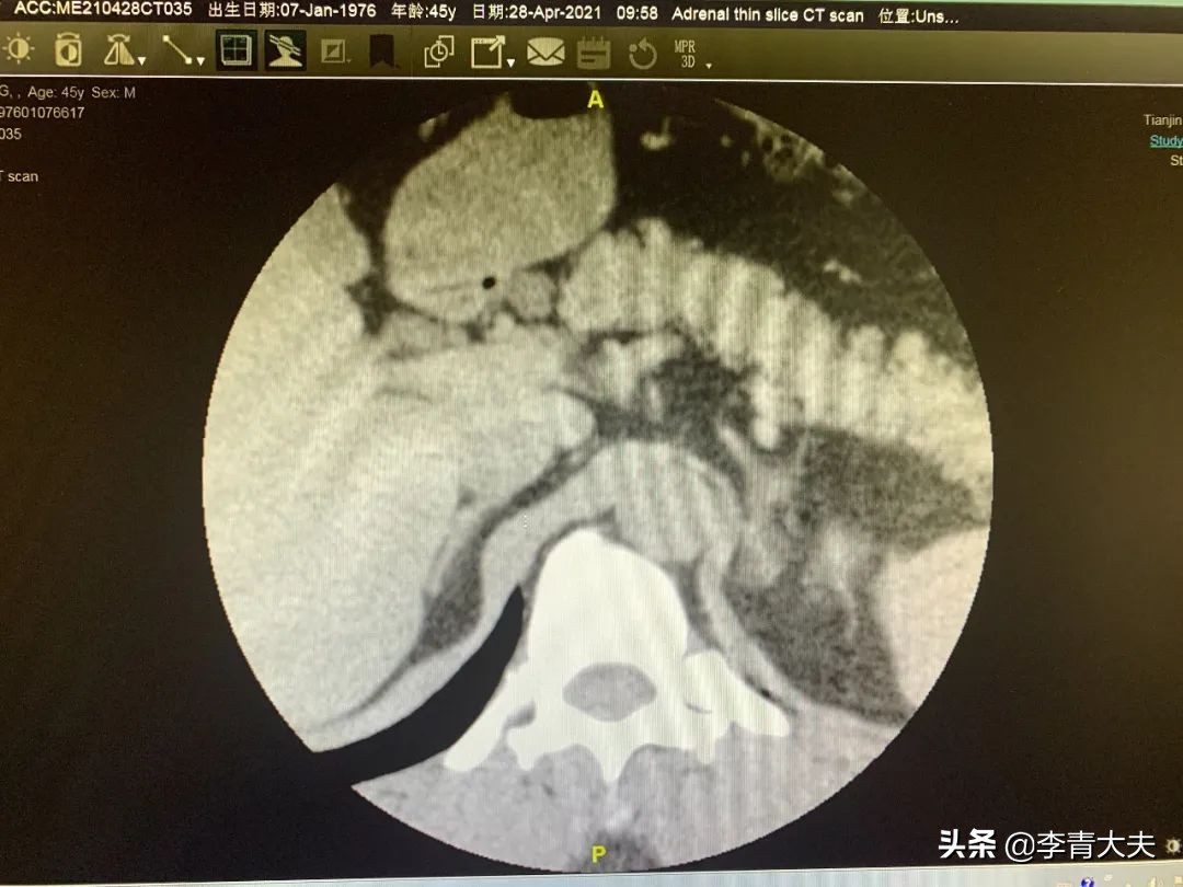 治愈严重顽固性高血压名医方子,能治好顽固高血压的著名老中医