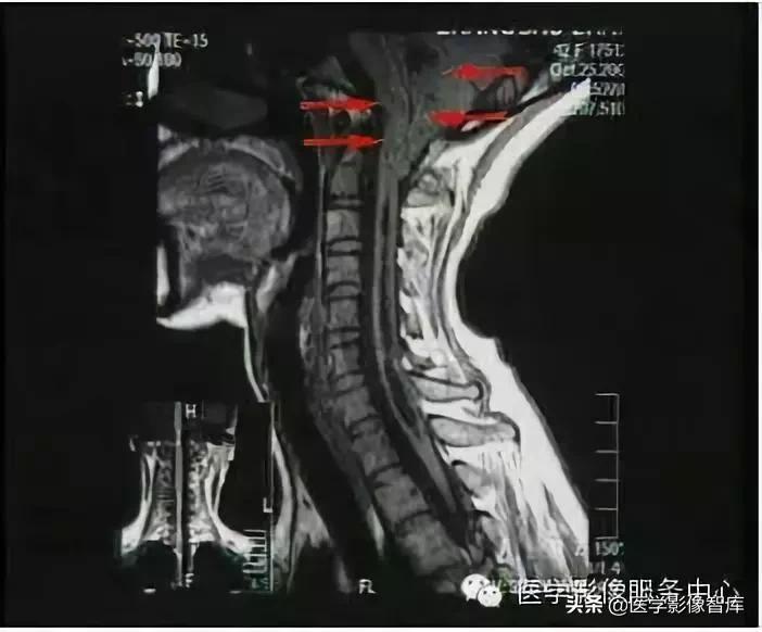 chiari畸形确诊,chiari畸形症状会一直有吗