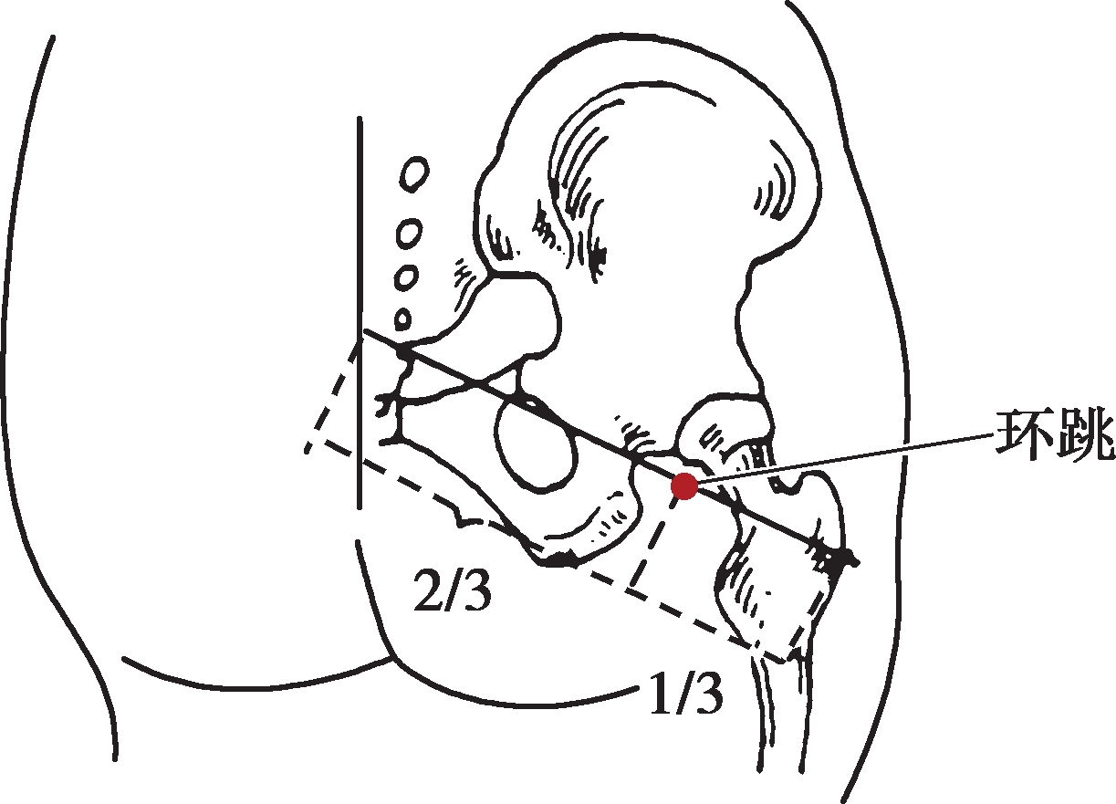 吕景山消肿穴位,环跳穴疼董氏针灸